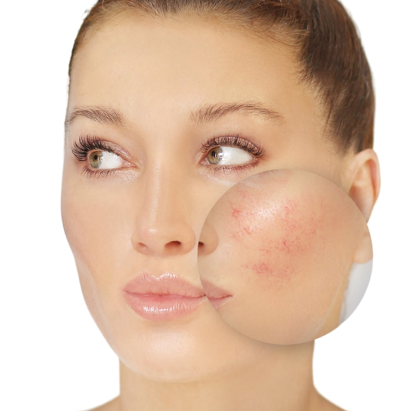 Welche Pflege hilft bei Hautrötungen & Irritationen?